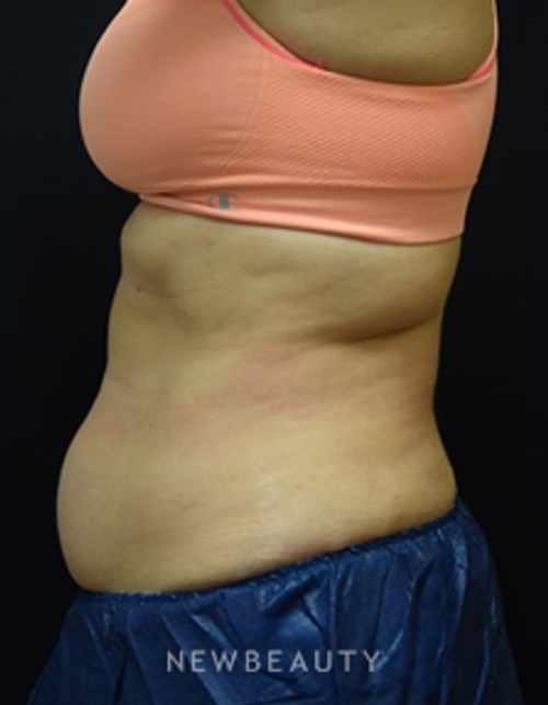 Dr. Jeffrey B. Wise - CoolSculpting - Before