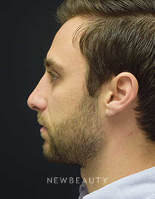 Dr. Jeffrey B. Wise - Rhinoplasty - After
