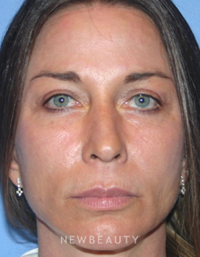 Dr. Kelly Bomer, Blepharoplasty, Browlift/Forehead Lift, Facelift, Chin Augmentation - After