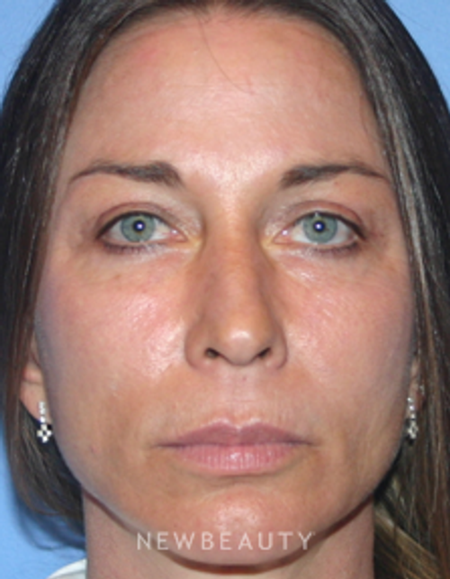 Dr. Kelly Bomer, Blepharoplasty, Browlift/Forehead Lift, Facelift, Chin Augmentation - After
