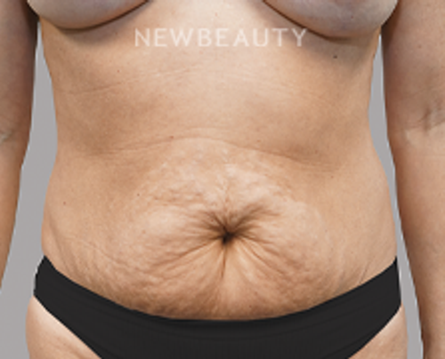 Dr. Jeffrey R. Antimarino - Tummy Tuck - 25108174 - Before