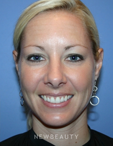 Dr. Kelly Bomer - Injectables & Fillers - After