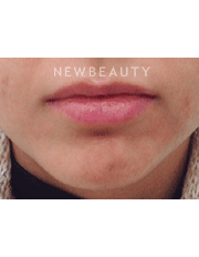 Dr. Julie Russack Injectables and Fillers - Before