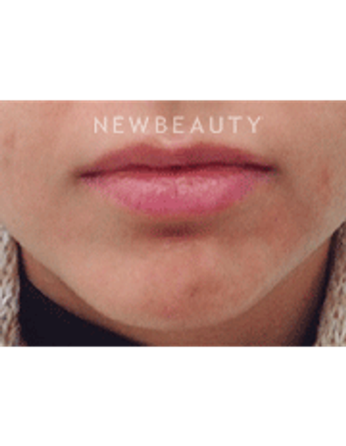 Dr. Julie Russack Injectables and Fillers - Before