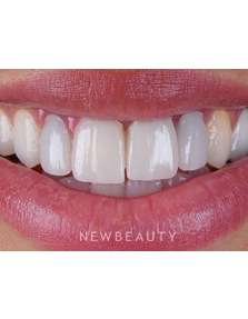 Dr. Husam Almunajed - Smile Makeover - Before