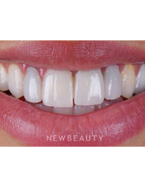 Dr. Husam Almunajed - Smile Makeover - Before