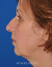 Dr. Edward Kwak - Rhinoplasty - Before