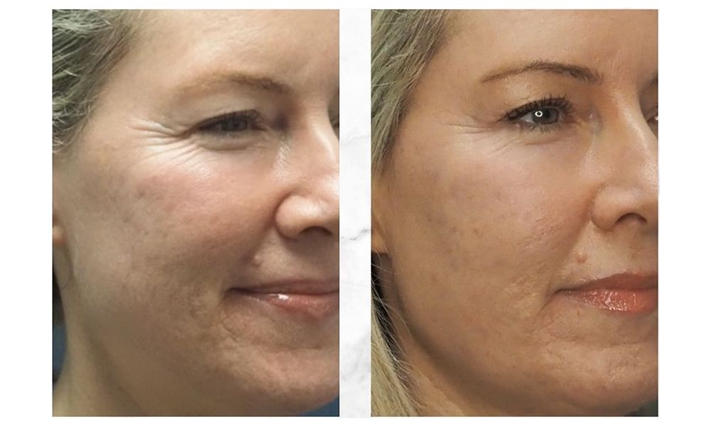 After a series of Enerjet treatments, three to her cheeks and two to her chin, Kim’s once-visible acne scars appear smoother and more refined.