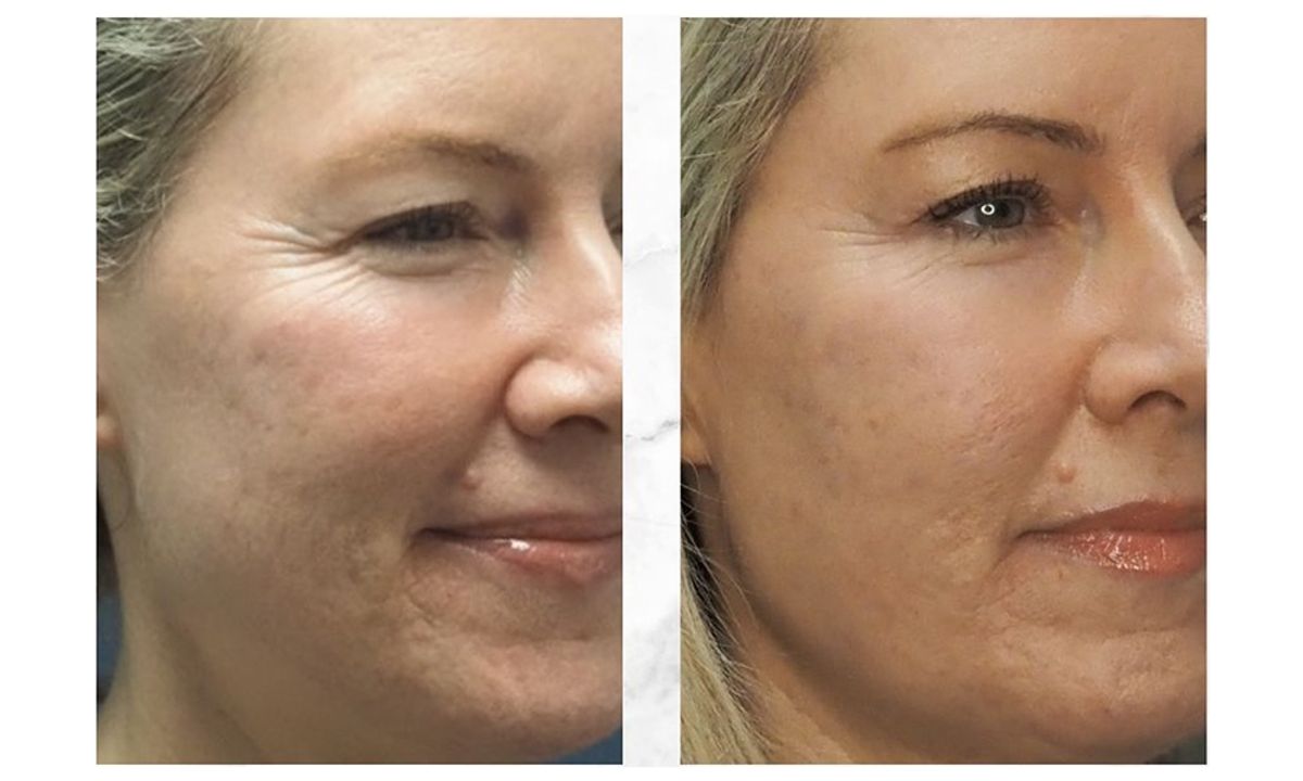 After a series of Enerjet treatments, three to her cheeks and two to her chin, Kim’s once-visible acne scars appear smoother and more refined.