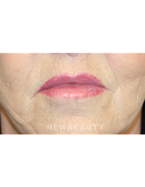Dr. Christine Hamori - Lip Lift - After
