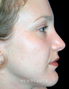 Dr. Kelly Bomer Rhinoplasty - After