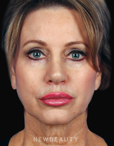 Dr. Kelly Bomer - Facelift - Before