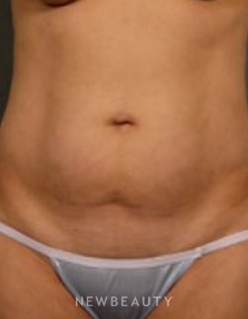 Dr. Aviva Preminger - Liposuction - Before