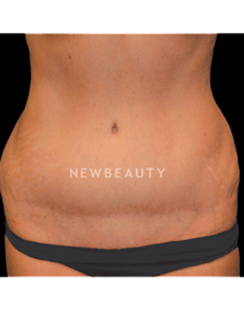 Dr. Christine Hamori Laser Liposuction, Skin Tightening - Before