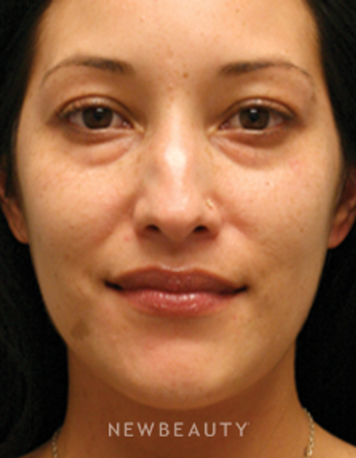 Dr. Jill Hessler - A Youthful Outlook - Before