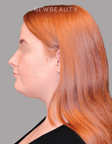 Dr. Shahin Fazilat - Liposuction - 46267441 - Before