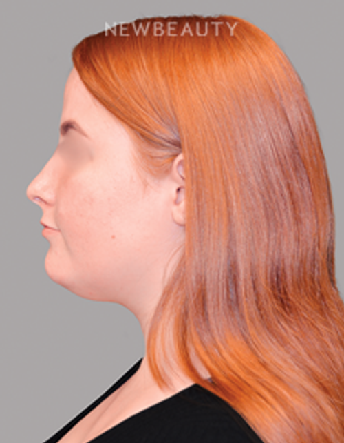 Dr. Shahin Fazilat - Liposuction - 46267441 - Before