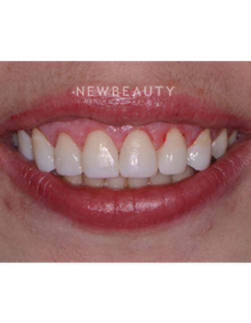 Dr. Irene Grafman - Gum Lift - After