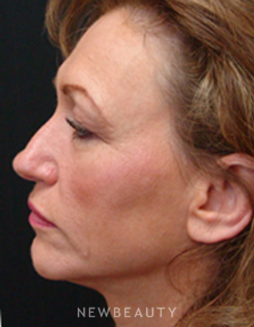 Dr. Mokhtar Asaadi Eyelid Lift, Rhinoplasty - Before