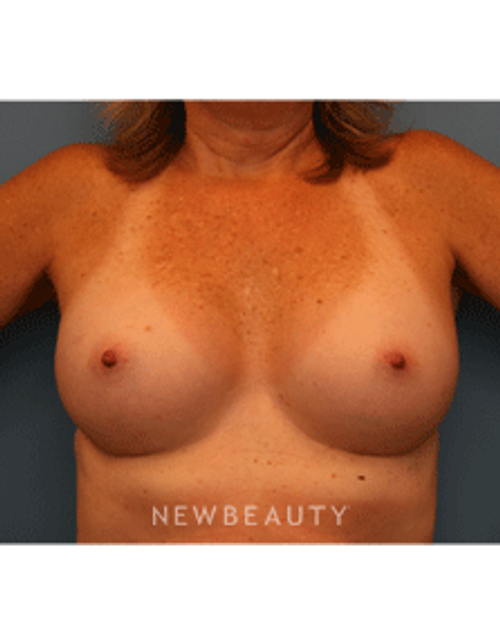 Dr. Christine Hamori Breast Augmentation - After