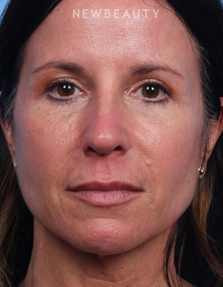 Dr. Kelly Bomer - Facelift - After