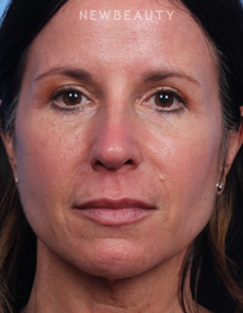 Dr. Kelly Bomer - Facelift - After