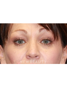 Dr. Dilip Madnani - Upper Blepharoplasty - After