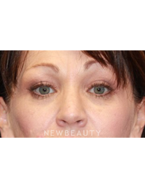 Dr. Dilip Madnani - Upper Blepharoplasty - After