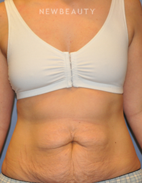 Dr. Bryan W. Gawley - Mommy Makeover - Before