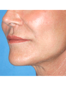 Dr. Kelly Bomer Liquid Facelift - After