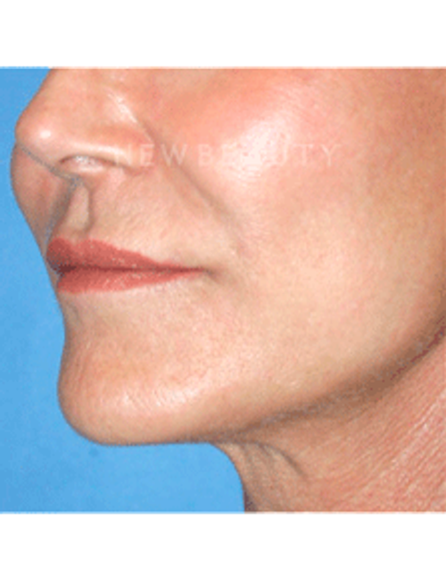 Dr. Kelly Bomer Liquid Facelift - After