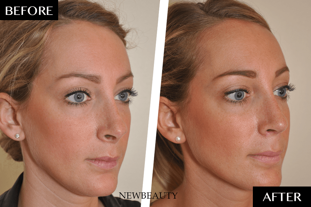 56776 36388 Rhinoplastyba2 1pngpng