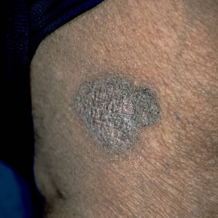 pigmented basal cell carcinoma 