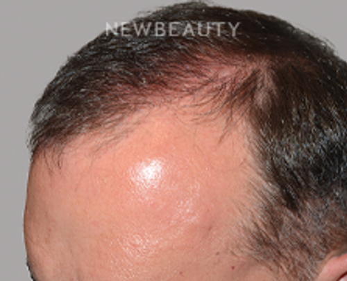 Dr. Jeffrey Epstein - Hair Transplant - 46167961 - After