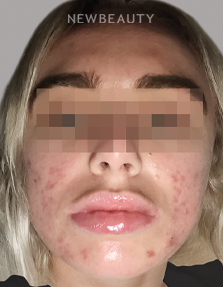 Dr. Anna Chacon – Acne Conglobata - 34277396 - After