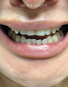 Dr. Lana Rozenberg – Smile Makeover – 47194502 - Before