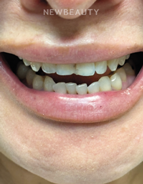 Dr. Lana Rozenberg – Smile Makeover – 47194502 - Before