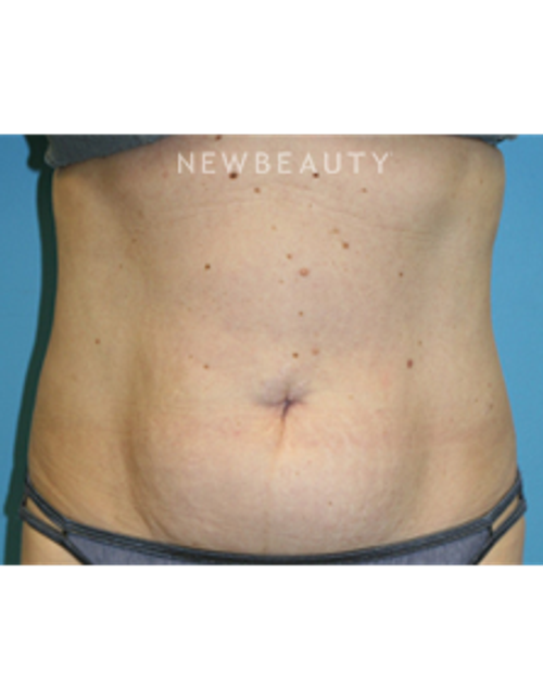 Dr. Christine Hamori - Tummy Tuck - Before