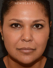 Dr. Janet Allenby - Liquid Facelift - Before