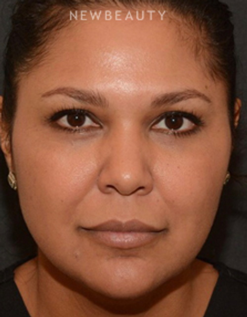 Dr. Janet Allenby - Liquid Facelift - Before