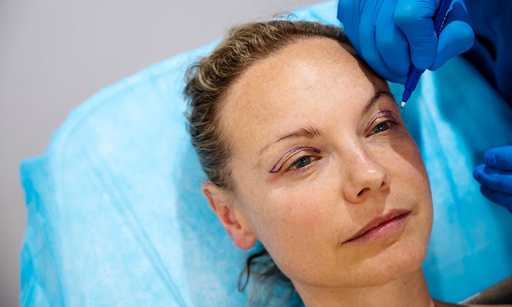 Surgeon drawing line on girl eye with marker preparing for procedure.