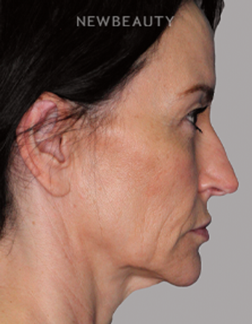 Dr. Philippe Capraro - Facelift at 40 - 35342372 - Before
