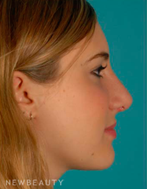 Dr. David Kim Rhinoplasty - After