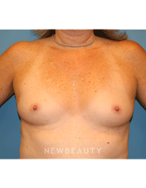 Dr. Christine Hamori Breast Augmentation - Before