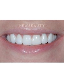 Dr. Guy M. Lewis - Smile Makeover - After