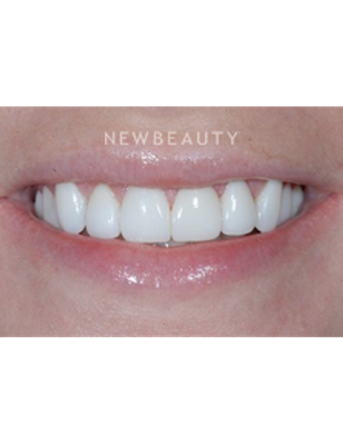 Dr. Guy M. Lewis - Smile Makeover - After