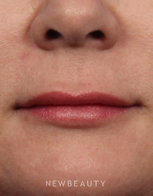 Dr. Kelly Bomer - Volumizing Difference - After