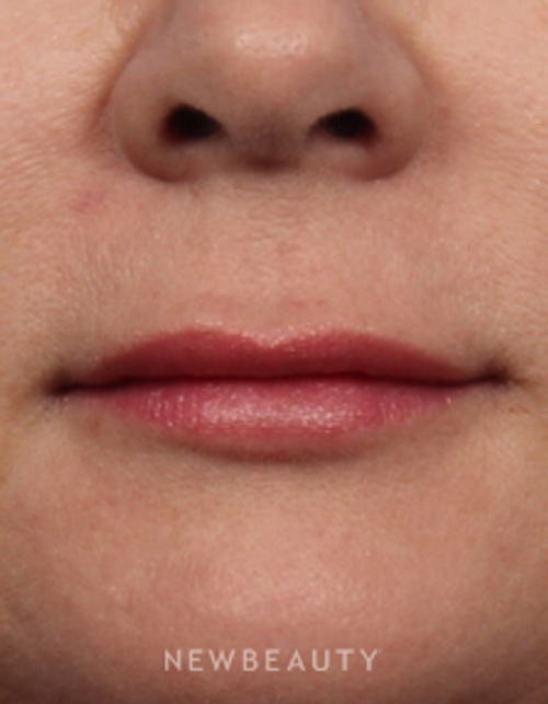 Dr. Kelly Bomer - Volumizing Difference - After
