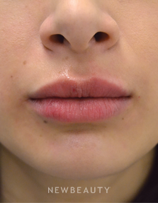 Dr. Julie Russak - Lip Enhancement - After
