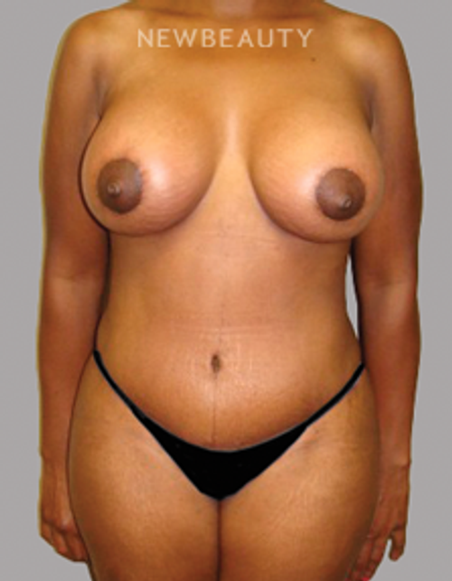 Dr. Sanjay Grover - Mommy Makeover - 49714108 - After